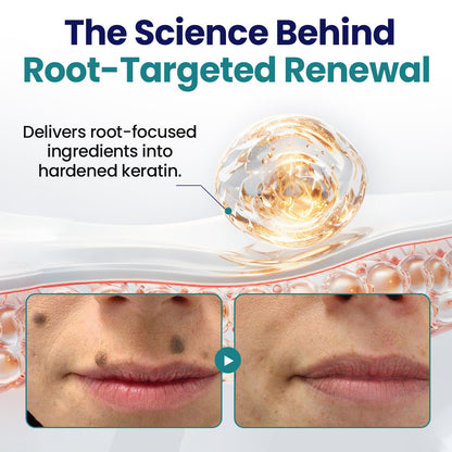 Timilk® WartLift Corn Removal Liquid 💝