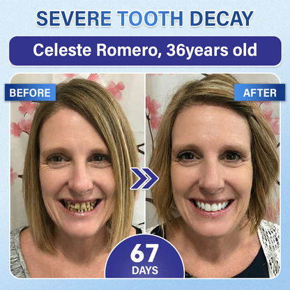 Your Smile🦷Ceoerty® Tooth & Gum Repair Fast-Dissolving Microneedle Patch✨ (𝟓-𝐢𝐧-𝟏 💎 𝐑𝐞𝐛𝐮𝐢𝐥𝐝 𝐄𝐧𝐚𝐦𝐞𝐥 & 𝐃𝐞𝐧𝐭𝐢𝐧 • 𝐒𝐭𝐫𝐞𝐧𝐠𝐭𝐡𝐞𝐧 𝐆𝐮𝐦𝐬 • 𝐄𝐫𝐚𝐝𝐢𝐜𝐚𝐭𝐞 𝐓𝐚𝐫𝐭𝐚𝐫 & 𝐎𝐝𝐨𝐫 • 𝐖𝐡𝐢𝐭𝐞𝐧𝐢𝐧𝐠 • 𝐒𝐭𝐨𝐩 𝐓𝐨𝐨𝐭𝐡 𝐒𝐞𝐧𝐬𝐢𝐭𝐢𝐯𝐢𝐭𝐲)