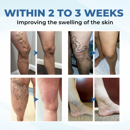 Timilk® TheraVein Varicose Herbal Spray