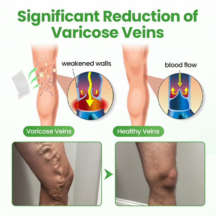 Healrize® VeinHeal Microneedle Patch