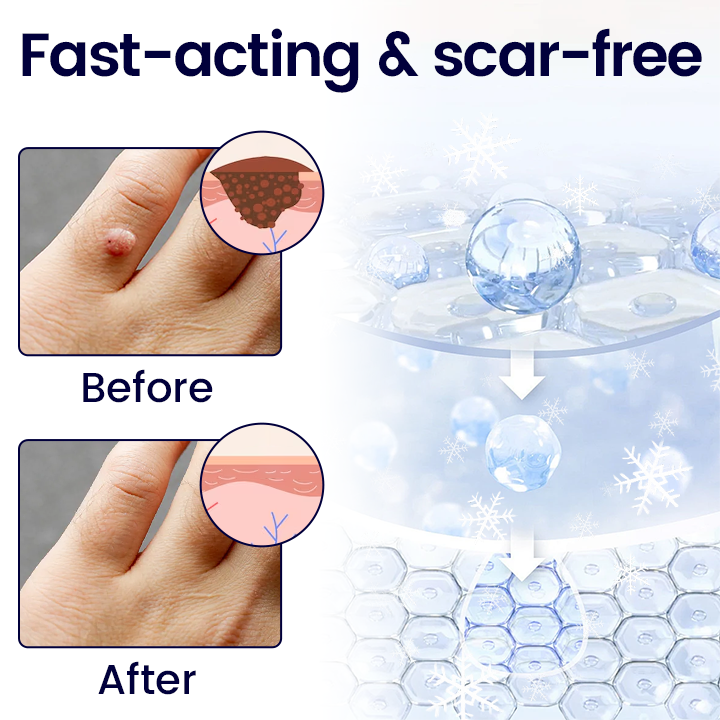 Timilk® WartErase Cryo Freeze Spray