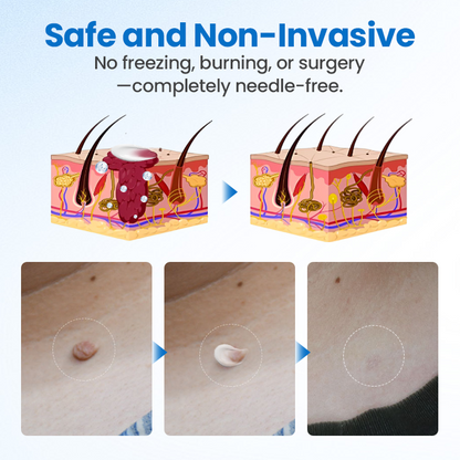 Timilk® TagGone Wart Removal Cream 💝