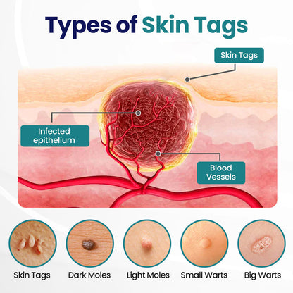 Timilk® WartLift Corn Removal Liquid 💝